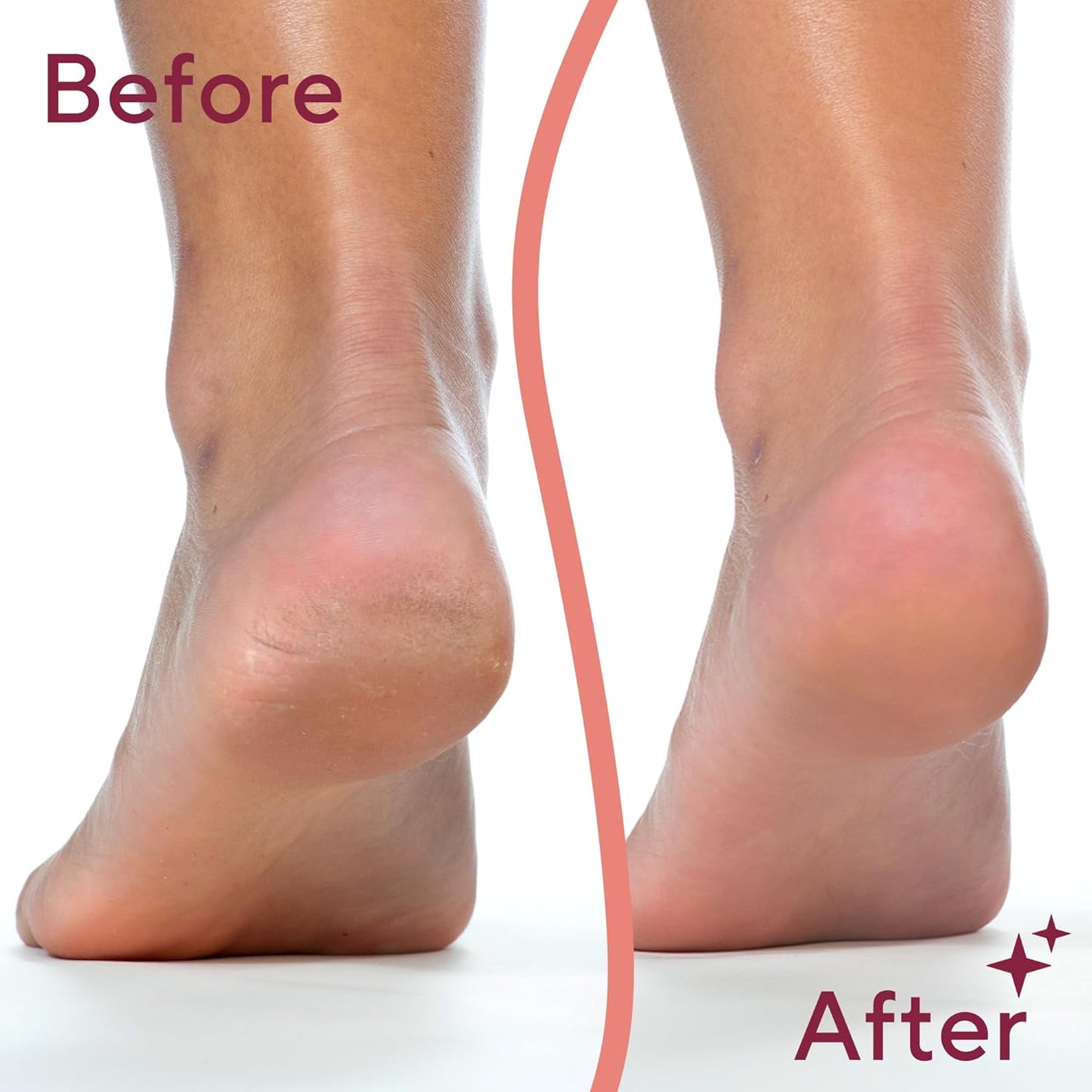 Foot Grinder – Electric Callus Remover